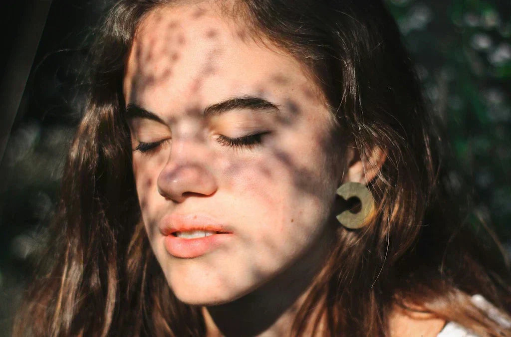 How to Get Rid of Acne Scars Through Skincare, Diet, and Sleep
