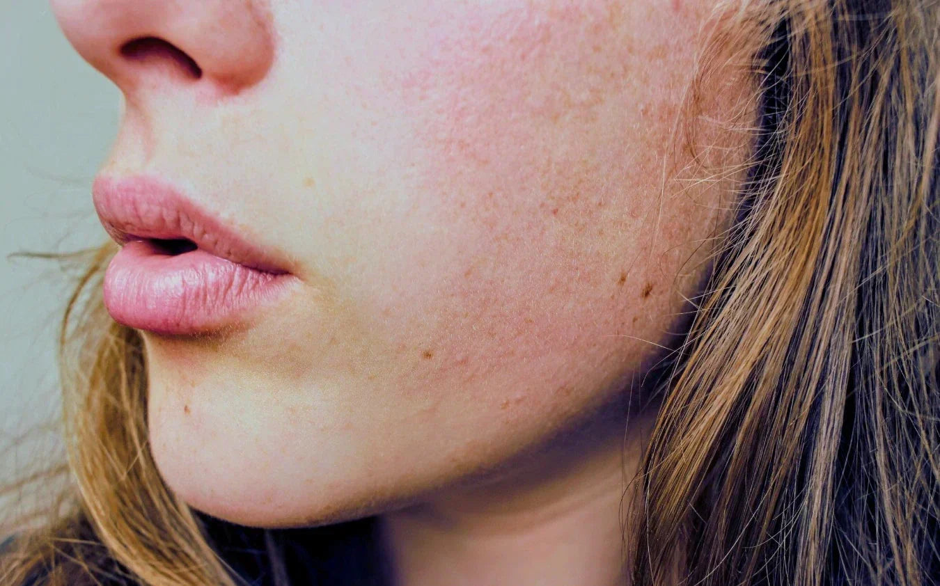 Dry Skin Treatments & Eczema Treatment 2026: The Ultimate Guide to Repair Your Skin Barrier