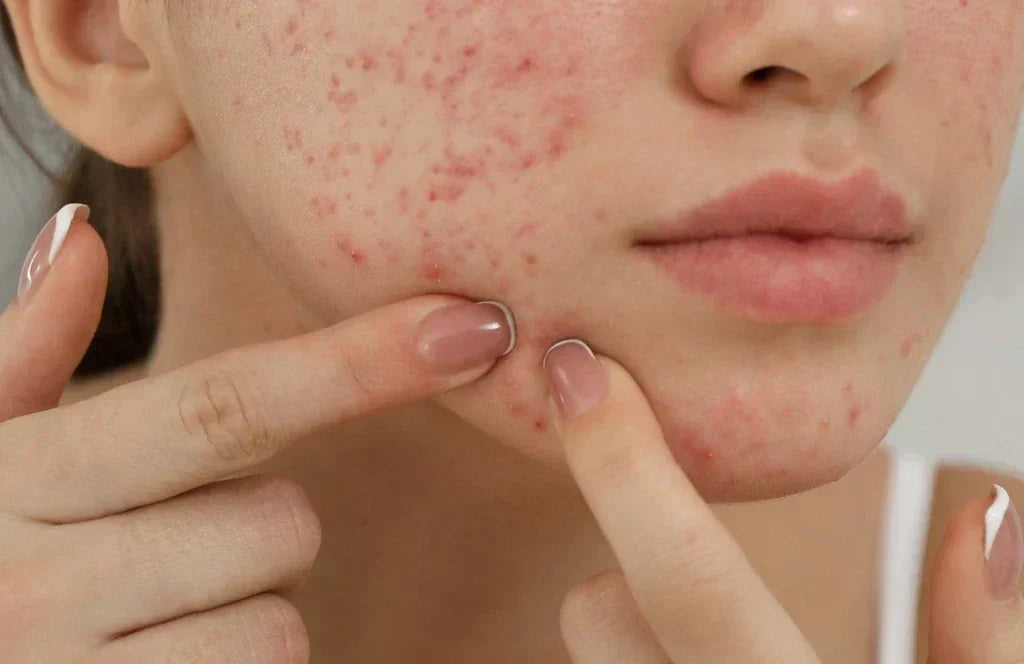 Hormonal Acne 2026: Causes, Triggers & How to Clear It Fast