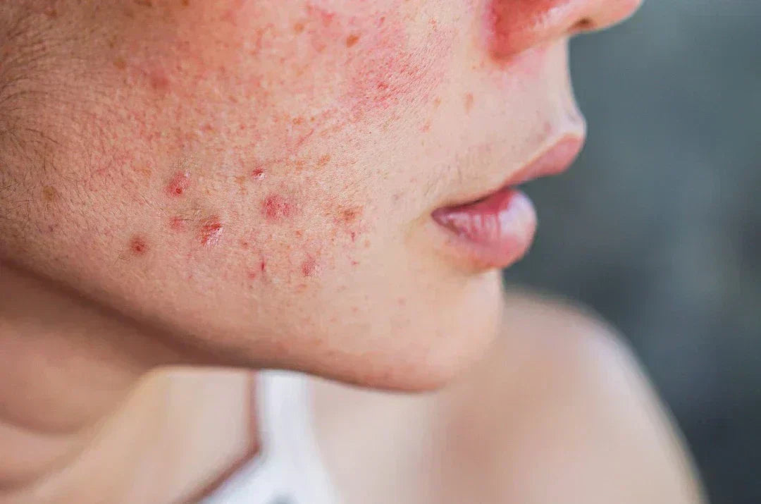How to Get Rid of Acne: 12 Proven Ways to Clear Your Skin Fast in 2026
