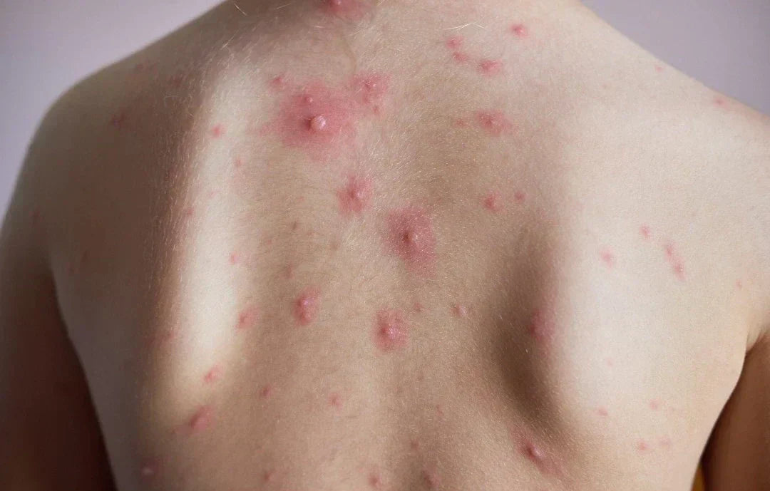 How to Get Rid of Back Acne: 12 Proven Ways to Clear Your Back Fast in 2026