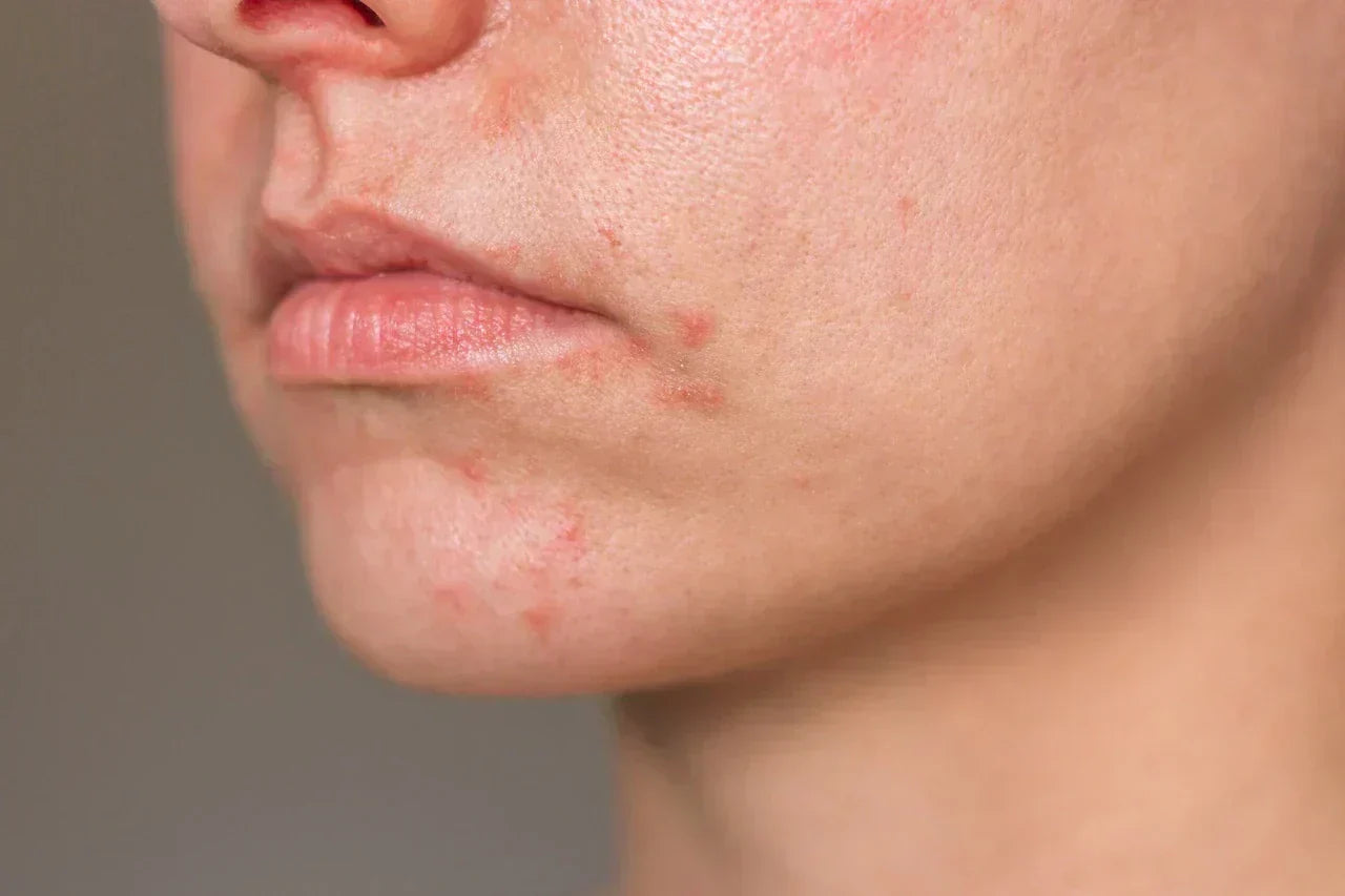 Does Silk Pillowcase Help with Acne? Dermatologist-Backed Guide